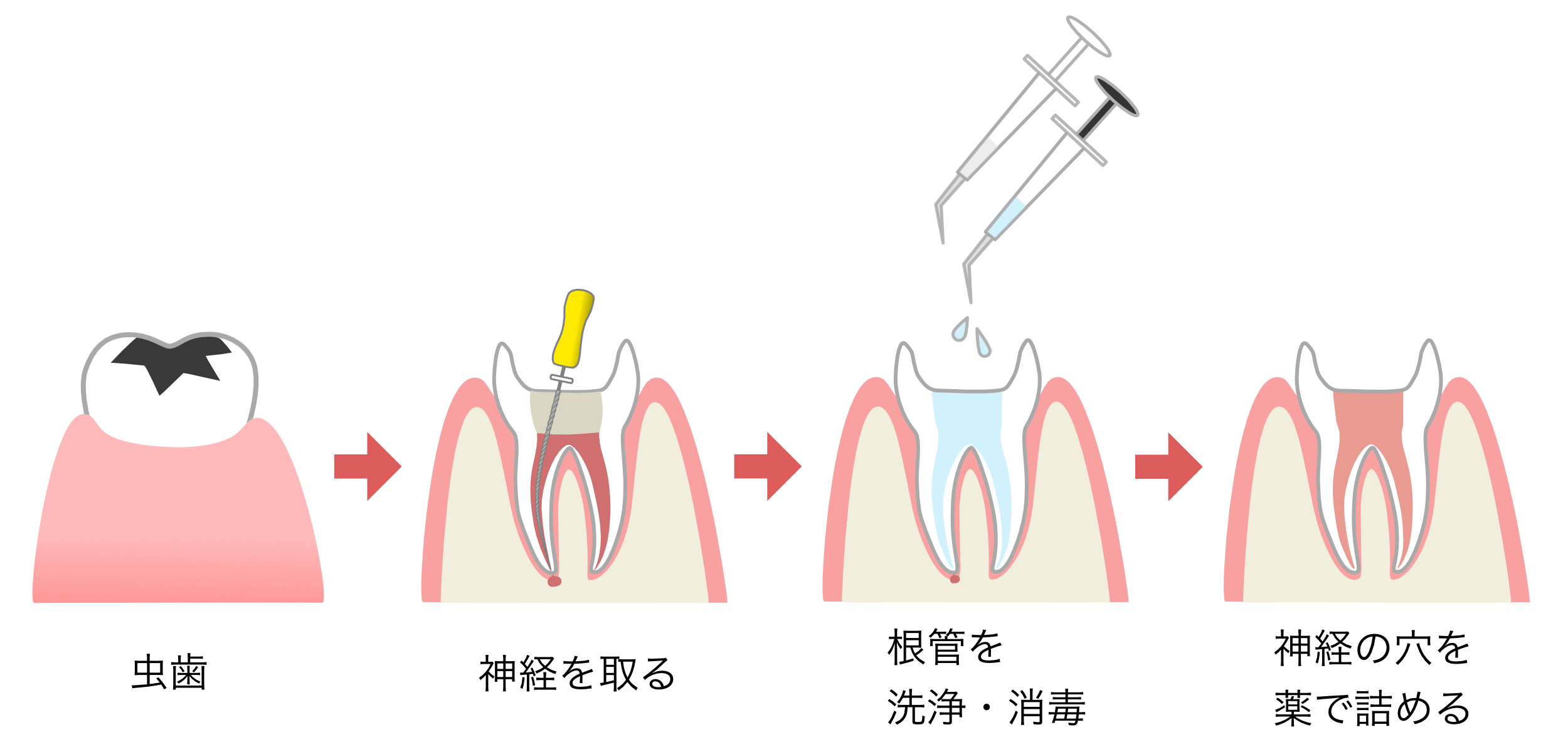 根管治療とは？マイクロスコープ？