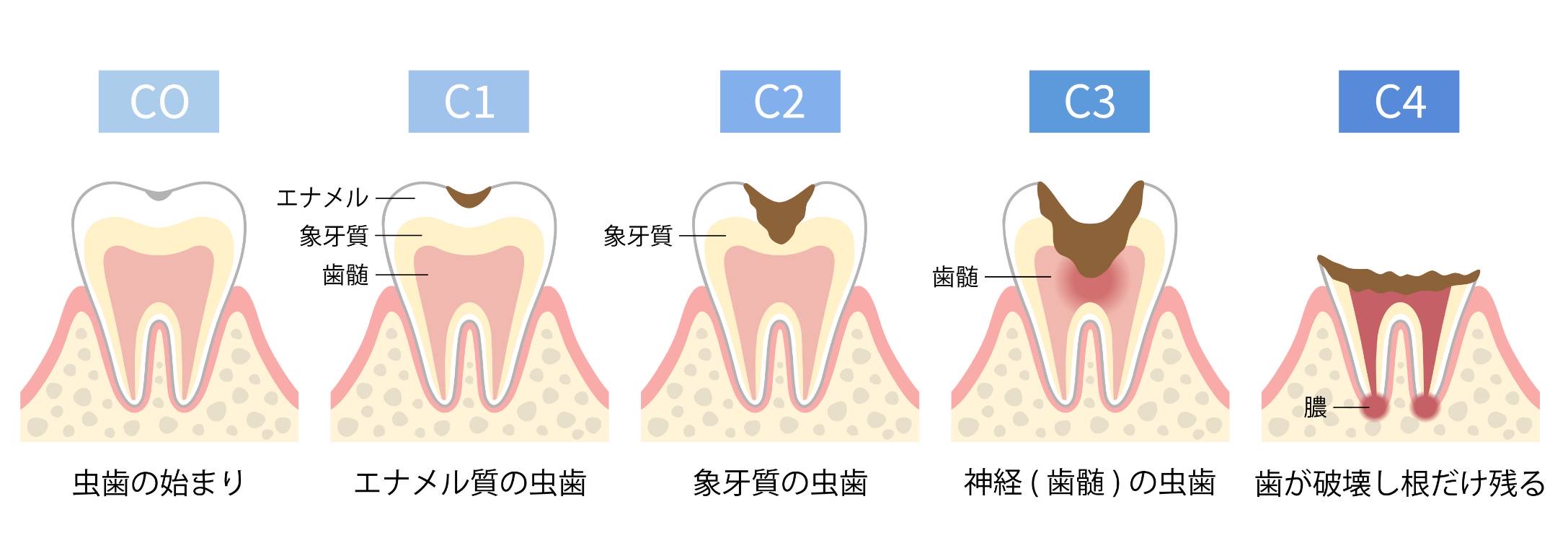 虫歯の治療ってどんなことをするの？