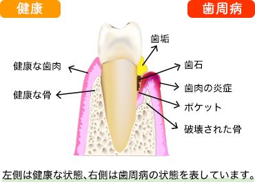 『歯周病』って言葉ではよく聞くけれどどんな病気？