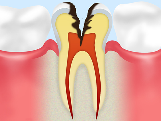 神経まで侵された虫歯（C3）
