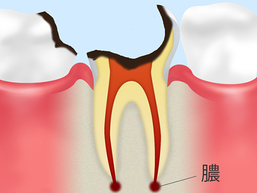 神経が死んで歯冠が崩壊した虫歯（C4）