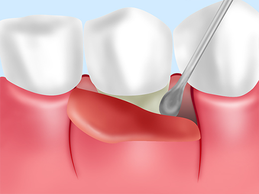 重度歯周病：歯周外科治療