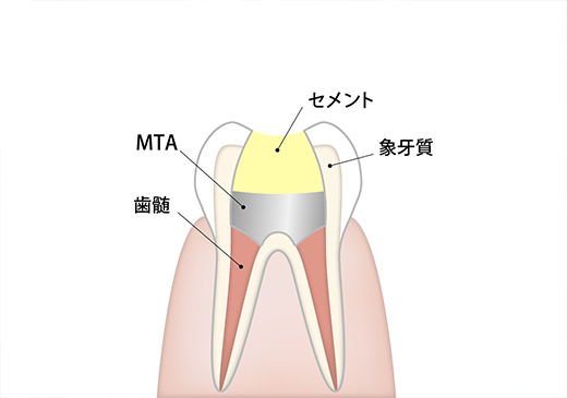 歯の神経を残す「MTAセメント」による治療